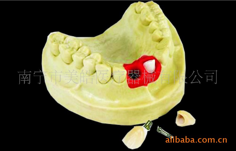 【口腔异味感小种植体固位性好耐用义齿假牙加