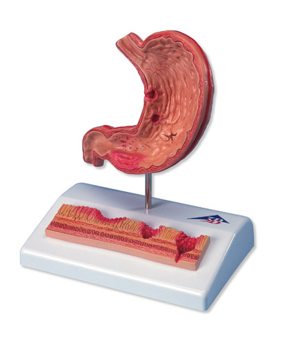 【进口胃溃疡模型模型人体内脏解剖模型人体解