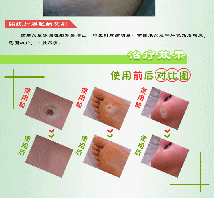 顺和堂 跖疣特效药 跖疣膏 趾疣 手足疣甲周疣 瘊子