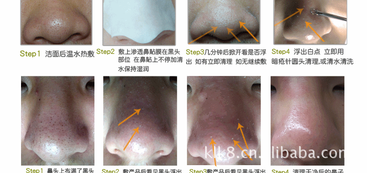 出液35g\/ml 5分钟去黑头白头 送鼻贴膜暗疮针】