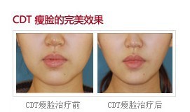 CDT微整形機器人