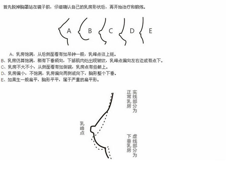 扁平胸型:扁平胸型表现为乳房稍隆起形似盘状,胸前壁的隆起多逐渐