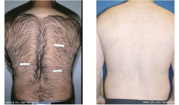 hair removal