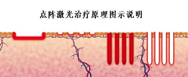 【11483】点阵激光美容仪|激光洗纹身机|激光