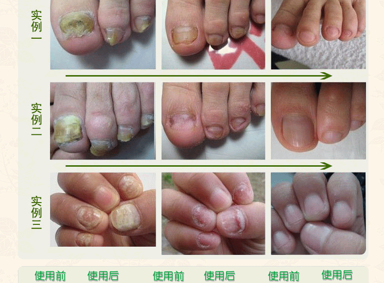 扬美 神笔甲康王修复灰指甲液 见效快恢复亮泽指甲