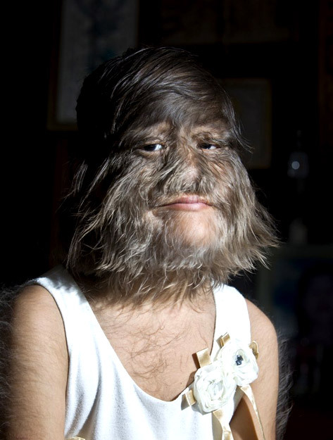 泰国女孩患多毛症脸长毛 犹如美猴王